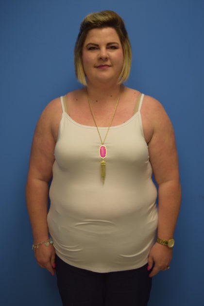 Gastric Sleeve Before & After Patient #328