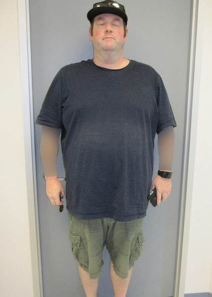 Gastric Sleeve Before & After Patient #352