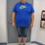 Gastric Sleeve Before & After Patient #381