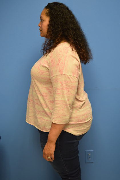 Gastric Sleeve Before & After Patient #400