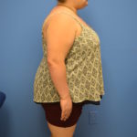 Gastric Sleeve Before & After Patient #518