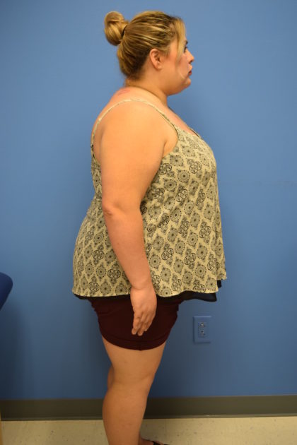 Gastric Sleeve Before & After Patient #518