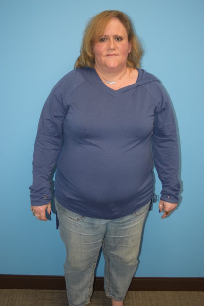 Gastric Sleeve Before & After Patient #523