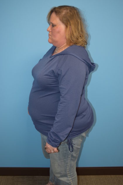 Gastric Sleeve Before & After Patient #523
