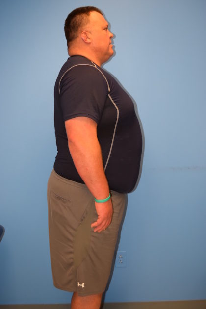 Gastric Sleeve Before & After Patient #533