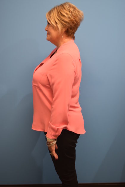 Gastric Sleeve Before & After Patient #538