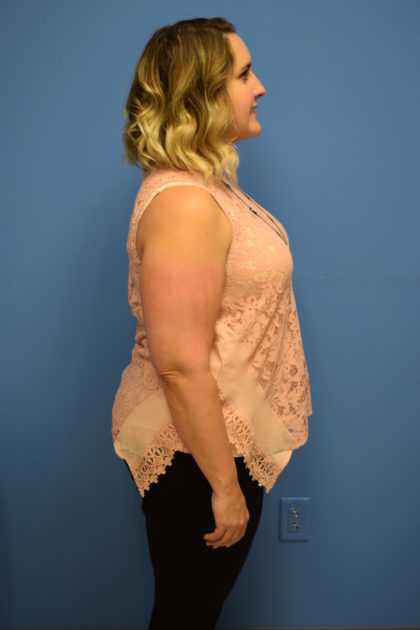 Gastric Sleeve Before & After Patient #543