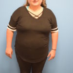 Gastric Sleeve Before & After Patient #558