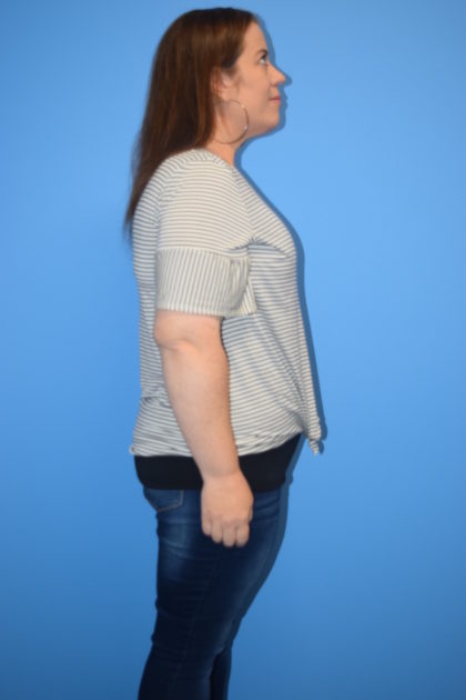 Gastric Sleeve Before & After Patient #568