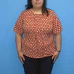 Gastric Sleeve Before & After Patient #563