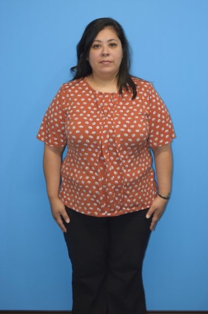 Gastric Sleeve Before & After Patient #563