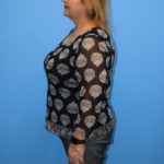 Gastric Sleeve Before & After Patient #624