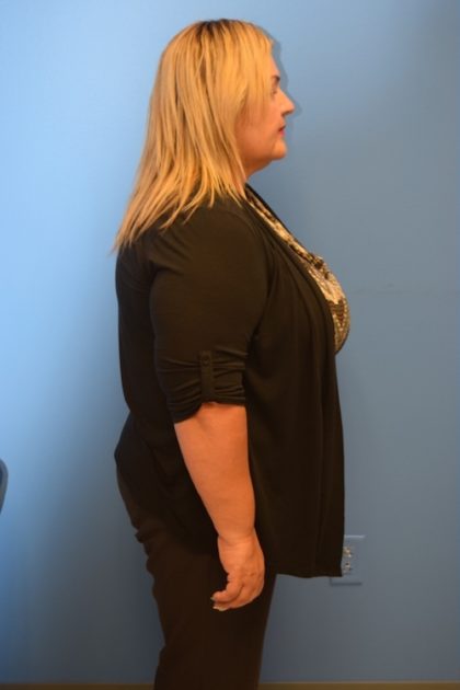 Gastric Sleeve Before & After Patient #624