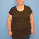 Gastric Sleeve Before & After Patient #638