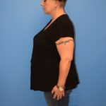 Gastric Sleeve Before & After Patient #638