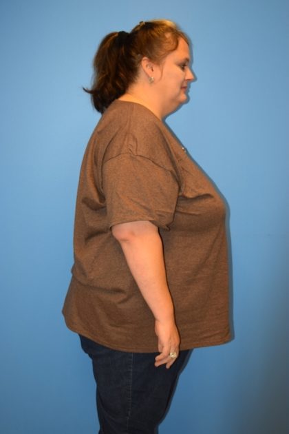 Gastric Sleeve Before & After Patient #645