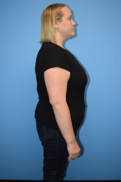 Gastric Sleeve Before & After Patient #789