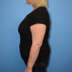 Gastric Sleeve Before & After Patient #789