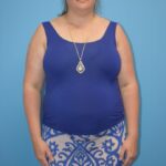 Gastric Sleeve Before & After Patient #803