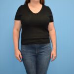 Gastric Sleeve Before & After Patient #803