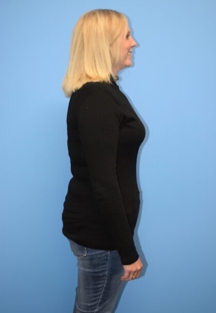 Gastric Sleeve Before & After Patient #768